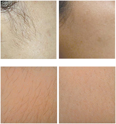 Laser Hair Removal